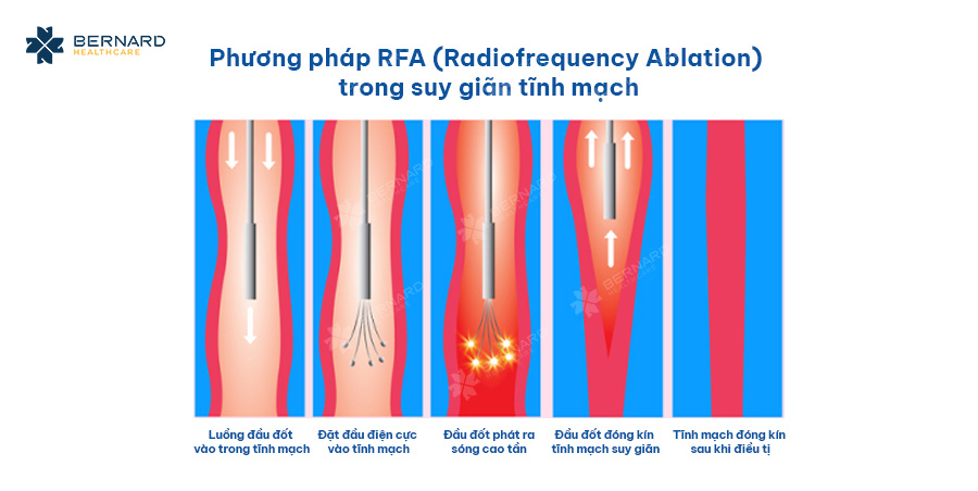 Phuong-phap-RFA-la-gi.jpg