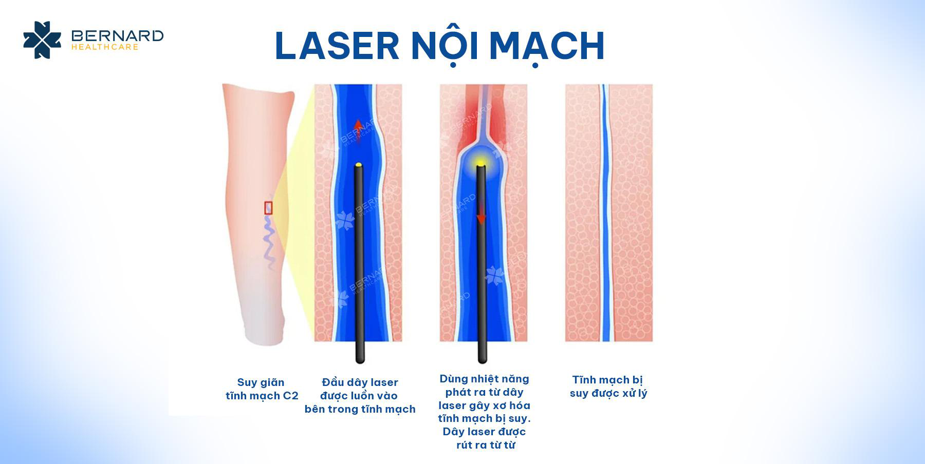 hinh-minh-hoa-co-che-dieu-tri-laser-noi-mach