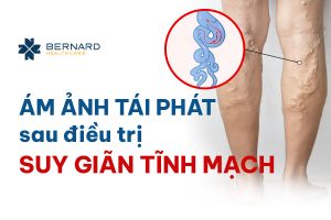 Tai-phat-suy-gian-tinh-mach.jpg