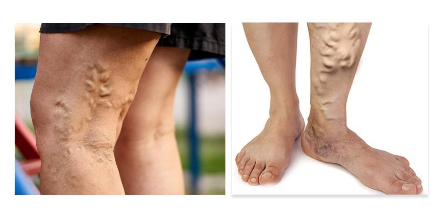 chân nổi búi mạch ngoằn ngoèo do bị suy giãn tĩnh mạch