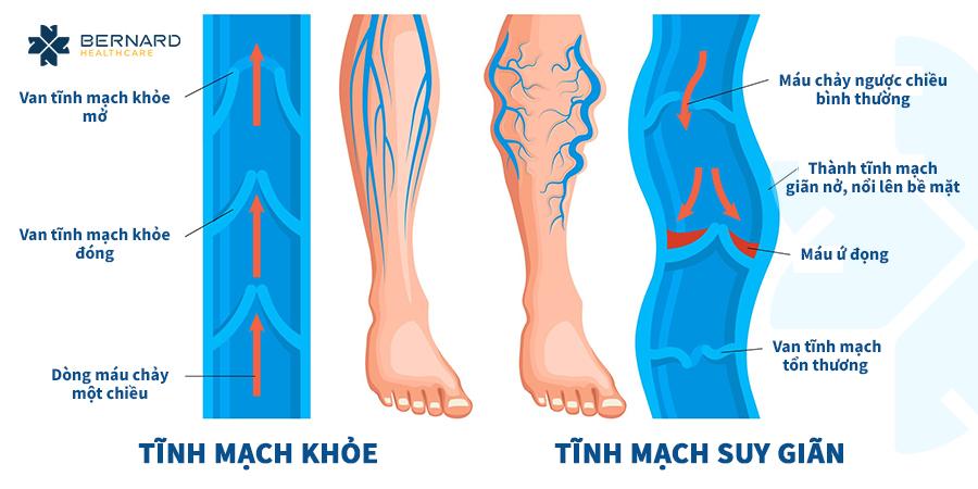 các dấu hiệu của chân bị giãn tĩnh mạch