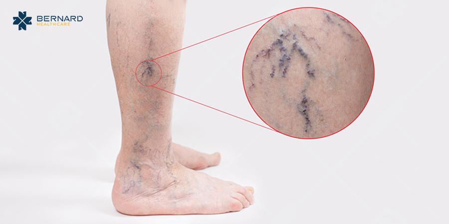 chân nổi gân xanh là bệnh gì
