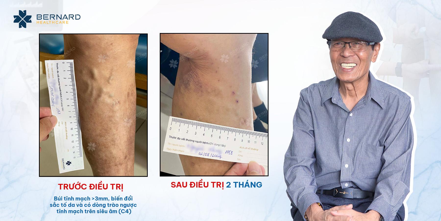 Hình ảnh trước và sau khi điều trị suy giãn tĩnh mạch của chú Phong bằng laser nội mạch