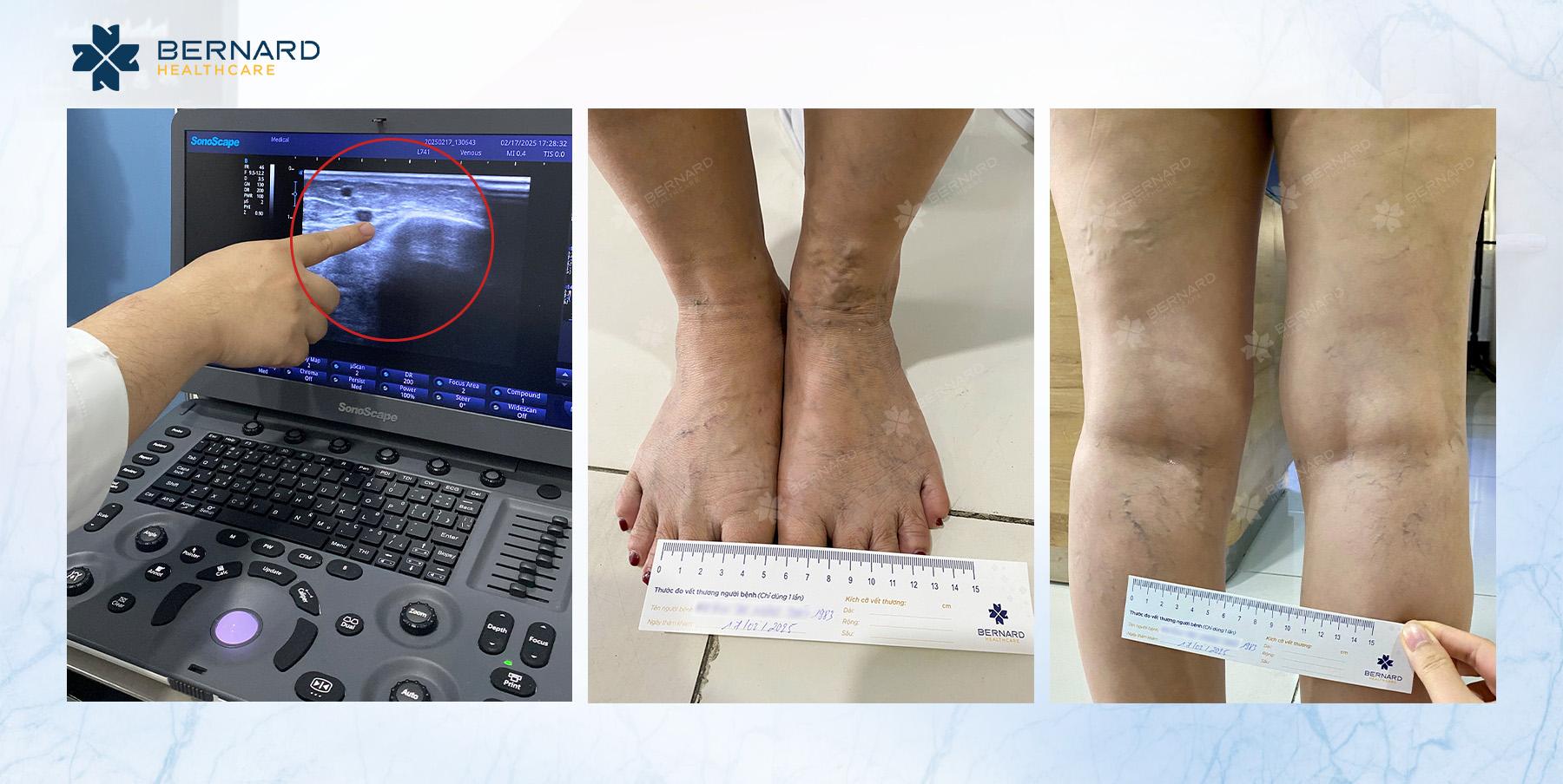 Tình trạng tái phát suy giãn tĩnh mạch của chị T. tiến triển mức độ C2