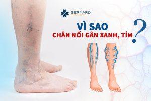 Vi-sao-chan-noi-gan-xanh-tim.jpg