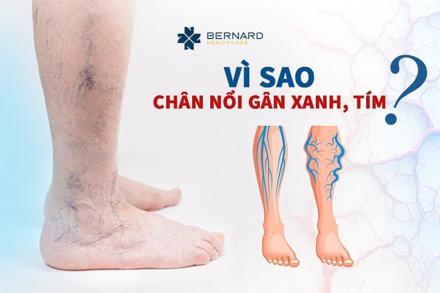 Vi-sao-chan-noi-gan-xanh-tim.jpg