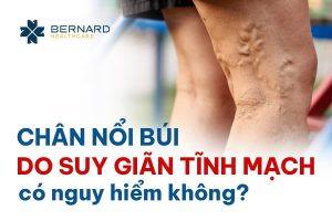 chan-noi-bui-do-suy-gian-tinh-mach-co-nguy-hiem-khong-1.jpg