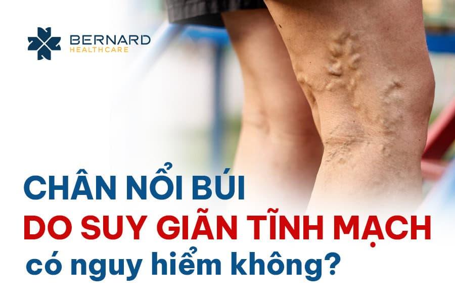 chan-noi-bui-do-suy-gian-tinh-mach-co-nguy-hiem-khong-1.jpg