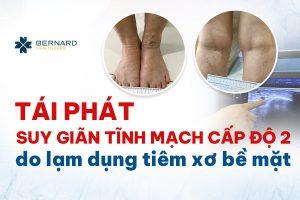 tai-phat-suy-gian-tinh-mach-cap-do-2-do-lam-dung-tiem-xo-be-mat