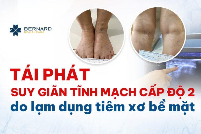 tai-phat-suy-gian-tinh-mach-cap-do-2-do-lam-dung-tiem-xo-be-mat
