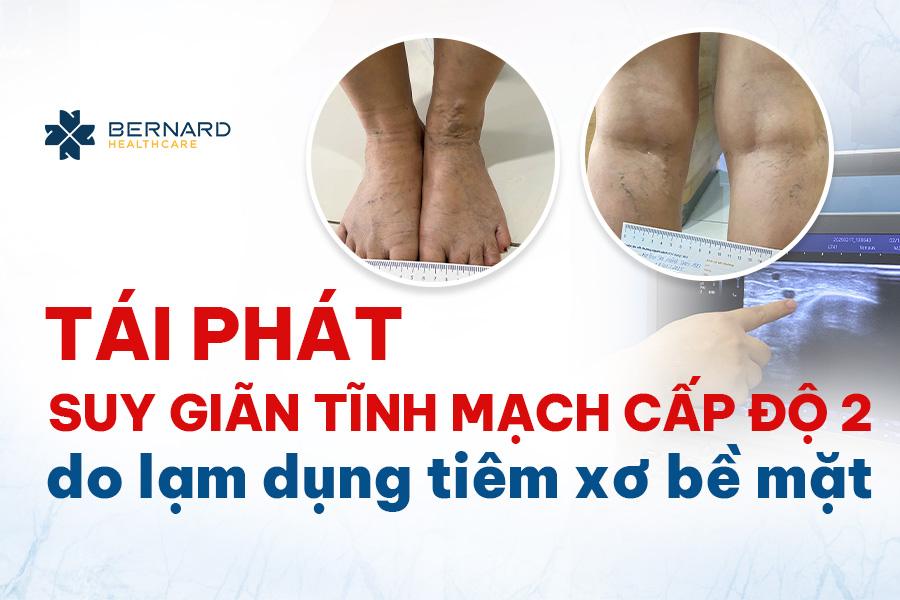 tai-phat-suy-gian-tinh-mach-cap-do-2-do-lam-dung-tiem-xo-be-mat