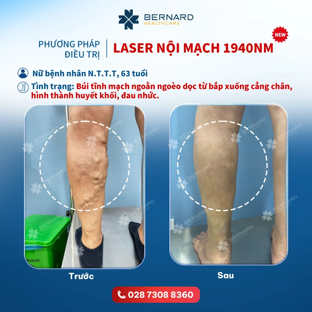 điều trị giãn tĩnh mạch bằng laser nội mạch 1940nm