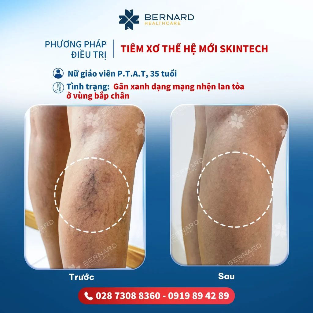 kết quả điều trị suy giãn tĩnh mạch bệnh nhân p.t.a.t