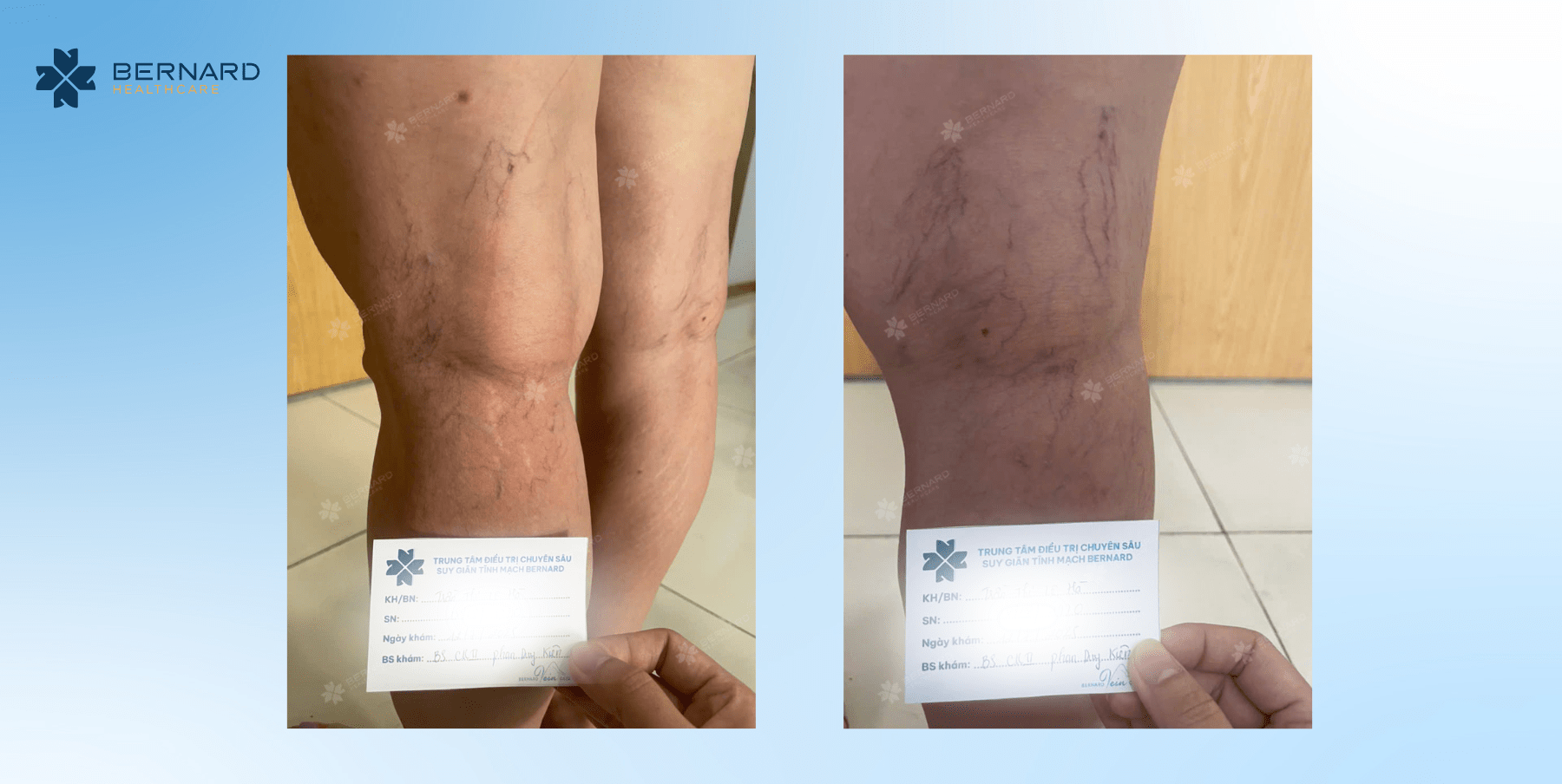 Hình ca thực tế điều trị tại Bernard do tái phát gân xanh sau tiêm xơlaser bề mặt tại cơ sở khác