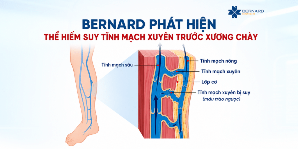 Bernard-phat-hien-the-hiem-suy-gian-tinh-mach-xuyen-truoc-xuong-chay-Nguon-suy-am-tham-khien-nhieu-nguoi-dieu-tri-nhieu-nam-khong-khoi.png