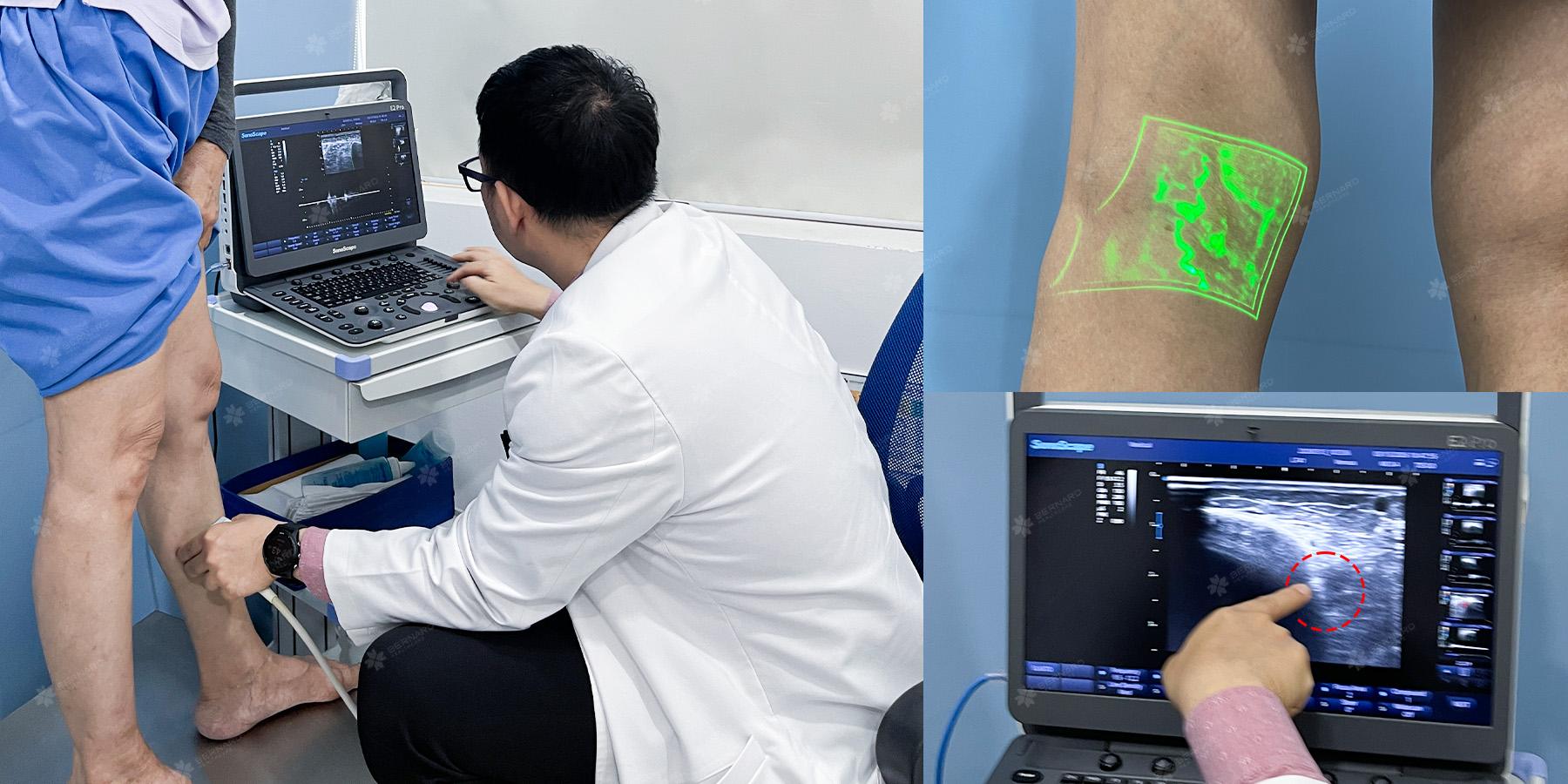Nữ bệnh nhân 66 tuổi được phát hiện suy tĩnh mạch xuyên trước xương chày kèm mạng lưới tĩnh mạch ẩn dưới da dày đặc.jpg
