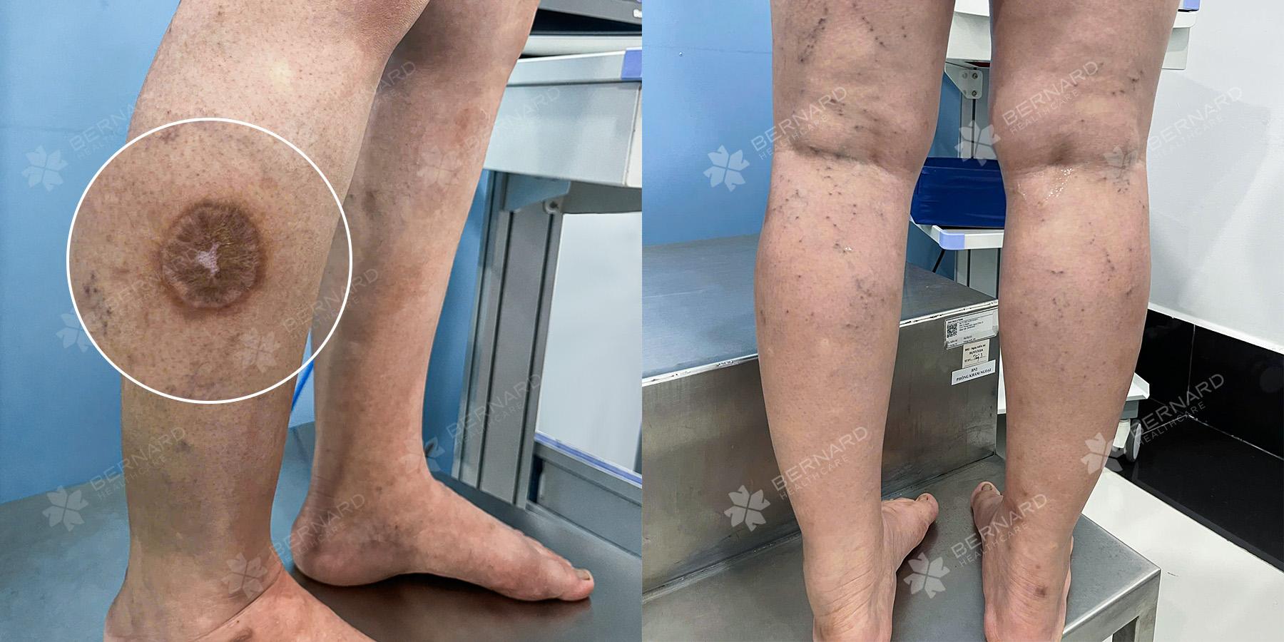 Nữ bệnh nhân gặp biến chứng viêm đau sau nhiều lần chích lể
