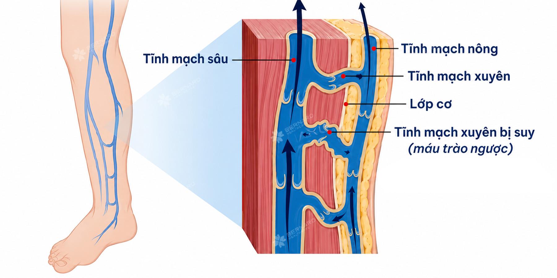 Suy tĩnh mạch xuyên trước xương chày - thể hiểm, dễ bỏ sót trong chẩn đoán