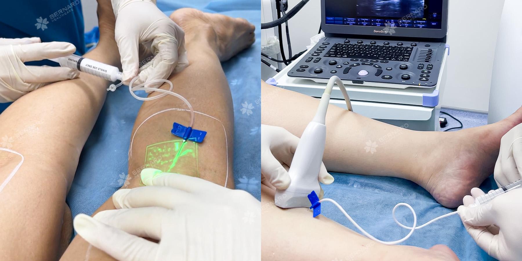 Nữ điều dưỡng điều trị suy giãn tĩnh mạch bằng pp tiêm xơ nội mạch bởi bác sĩ mạch máu Phan Duy Kiên tại Bernard Vein Care